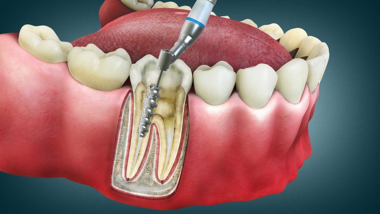 The Root Canal Process: Step-by-Step Breakdown