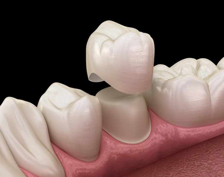 Common Problems with Dental Crowns and How to Fix Them